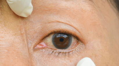 आंखों में एलर्जी के घरेलू उपाय – Home remedies for Allergies in eyes