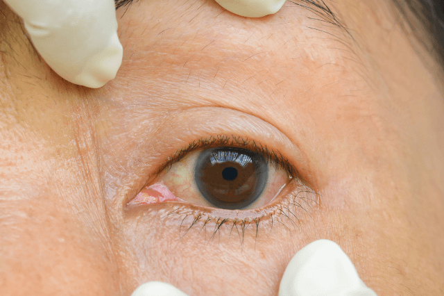 आंखों में एलर्जी के घरेलू उपाय - Home remedies for Allergies in eyes