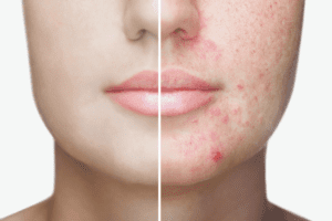 मुंहासे होने का कारण और उपाय – Acne causes and remedies