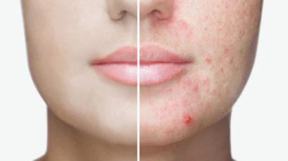 मुंहासे होने का कारण और उपाय – Acne causes and remedies