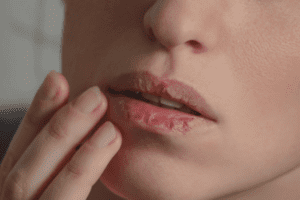 होंठ सूखने का कारण और उपाय – Causes and Remedies for Dry Lips