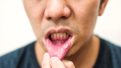 मुंह के छाले के उपचार – घरेलू उपाय